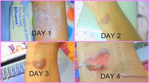 How To Cover A Burn Blister With Makeup - Mugeek Vidalondon