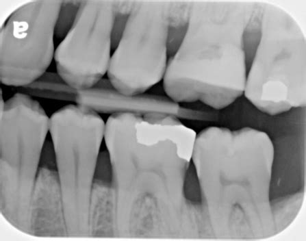 Week (-3) Bitewing X Ray Technique Flashcards | Quizlet