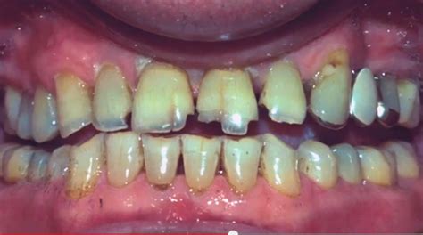 Bruxism - Prevention and Treatment