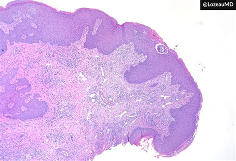 Acrochordon Histology