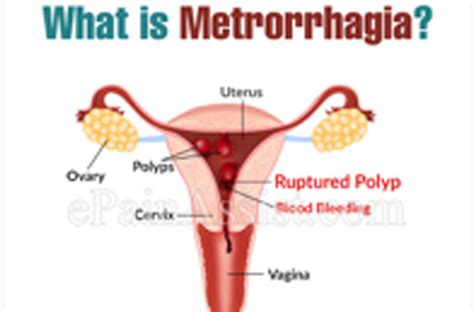 Metrorrhagia