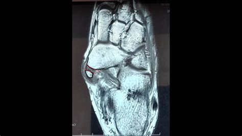 The Accessory Navicular - Clinical, Radiographic and Surgical ...