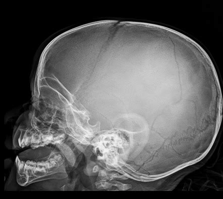 Simple Skull Fracture