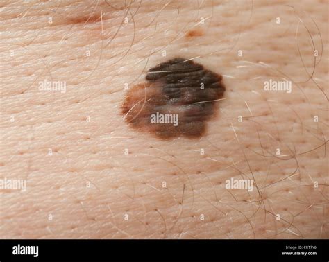 Un gros grain de beauté sur le dos d'un homme montrant des signes de ...