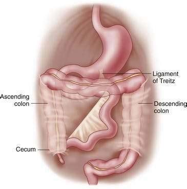 Malrotation: Ladd Procedure | Obgyn Key