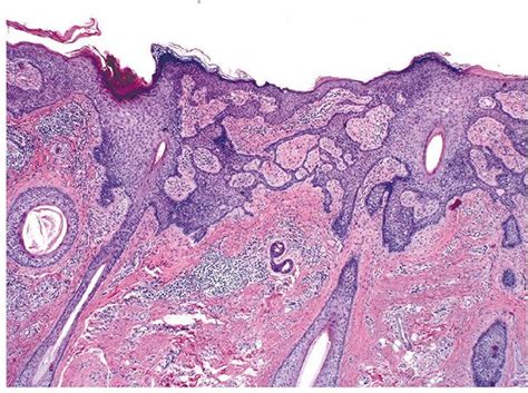 Tumors of the Epidermal Appendages | Plastic Surgery Key