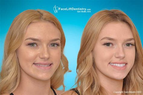 Facelift Dentistry - Above and Beyond Cosmetic Dentistry