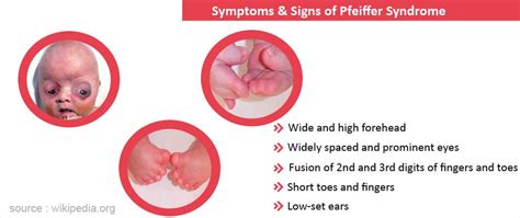 Pfeiffer Syndrome - Causes, Symptoms, Diagnosis, Treatment & Prevention