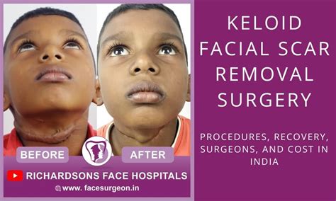 Keloid Facial Scar Removal | Procedures, Recovery, Surgeons, and Cost in India – Richardson's ...