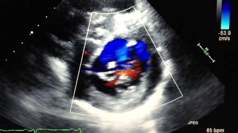 Mitral valve cleft - YouTube