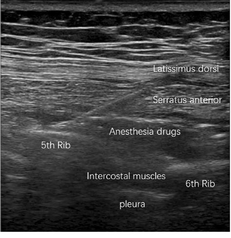 Ultrasound imaging of the deep serratus anterior plane block | Download ...