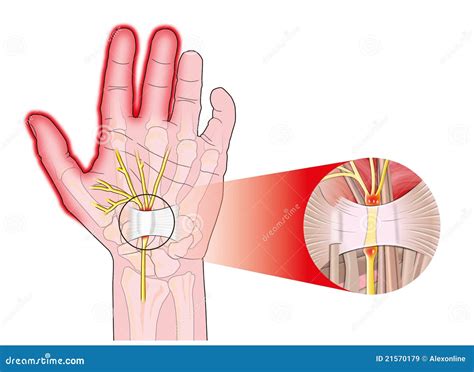 Transverse carpal ligament stock illustration. Illustration of flexor ...