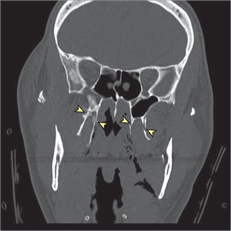 Lateral Pterygoid Plate Fractures and Jaw Fracture | JAMA Facial Plastic Surgery | The JAMA Network