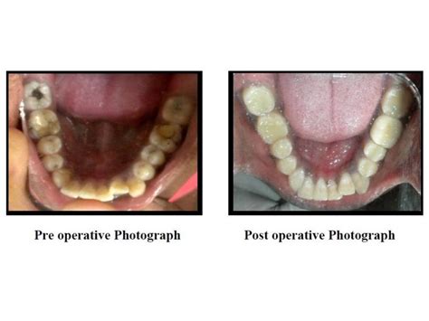 Importance of Crown on Root Canal Treated Tooth