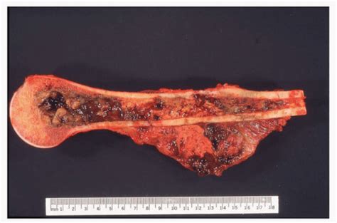 Malignant Fibrous Histiocytoma | Musculoskeletal Key