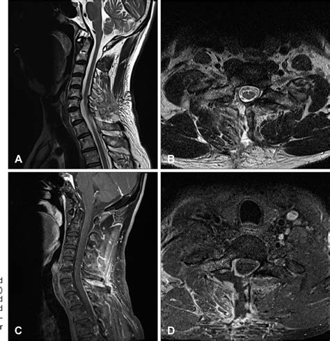 Ligamentum Flavum Cervical Spine