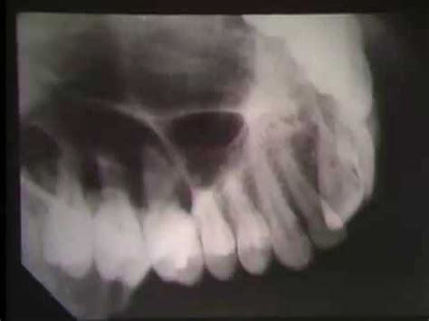 Occlusal Radiography - YouTube