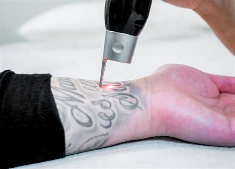 How Tattoo Removal Works – Complete Tattoo Removal - Skindevour