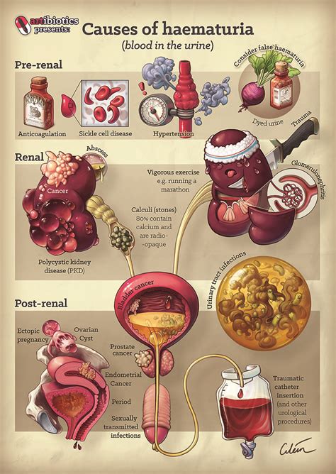 Causes of blood in the urine (haematuria) — artibiotics