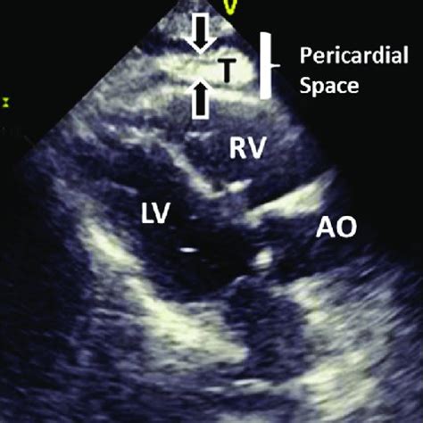 (PDF) Complications of pericardiocentesis: A clinical synopsis