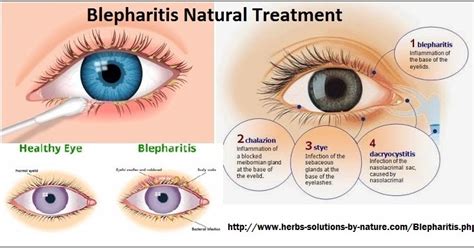 4 Home Base Natural Treatments for Blepharitis