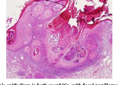 Figure 1 from Necrotizing sialometaplasia after lower lip wedge ...