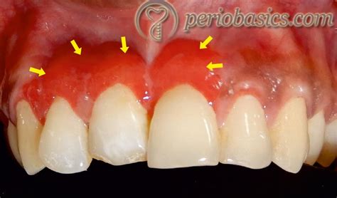 Desquamative gingivitis - periobasics.com Clinical Periodontology