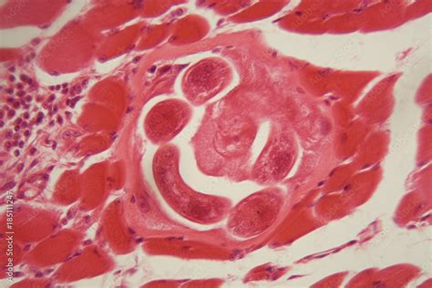 Trichinella spiralis larvae in muscle tissue under the microscope ...