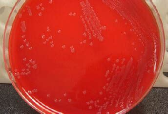 Laboratory testing - A CASE STUDY INVOLVING A NEISSERIA MENINGITIDIS INFECTION