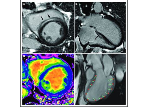 Typical CMR images for non-ischemic cardiomyopathy. A, Short axis image ...