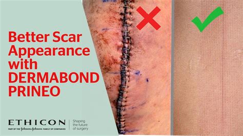 Benefits of DERMABOND PRINEO over Skin Staples to Close Skin Incision After Surgery | Ethicon ...