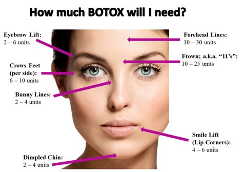 Image result for Botox Injection Sites Chart Botox Injection Sites ...