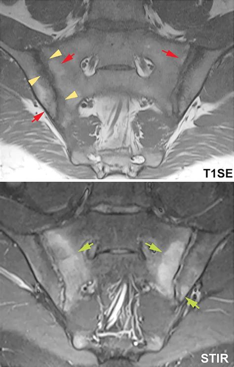 Ankylosing Spondylitis Mri