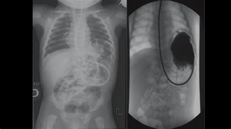 Gastric volvulus - Don't Forget the Bubbles