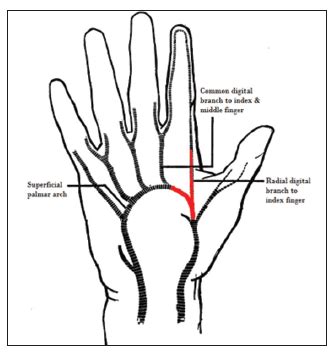 Schematic depicting the normal superficial palmar arch anatomy ...