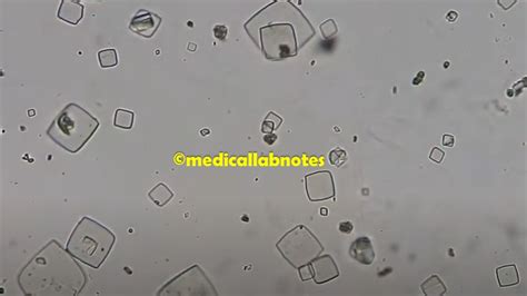 Urate Crystals or Uric acid Crystals in Urine Microscopy Archives ...