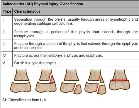 Salter-Harris Classification | physeal injuries are classified by the salter harris sh ...