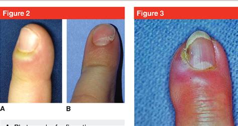 [PDF] Acute and Chronic Paronychia of the Hand | Semantic Scholar