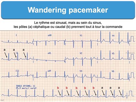 Wandering Atrial Pacemaker Rhythm Strip