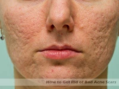 How to Get Rid of Bad Acne Scars - 3 easy tips | Hormonal Acne Tips