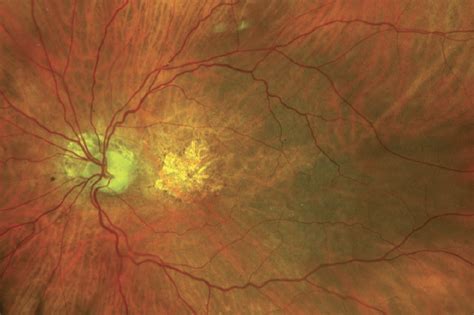 Recent Happenings in the Geographic Atrophy Space - Retina Today