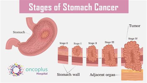 Stomach cancer - Best oncologist in Delhi - Oncoplus Hospital