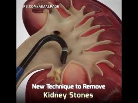 Kidney stent - YouTube