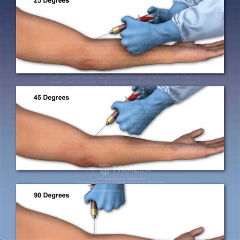 Venipuncture - TrialExhibits Inc.