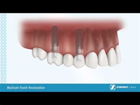 Zimmer Dental Implants - YouTube