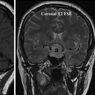 Brain MRI scans showing blood and hemostatic material (a) in the sella... | Download Scientific ...