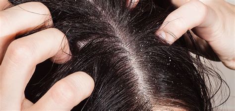 What Causes Dandruff In Hair