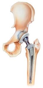 Anterior Hip Replacement - Orthopedic Specialists of Seattle