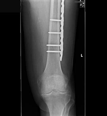 Periprosthetic and Peri-implant Fractures Treatment & Management: Approach Considerations ...