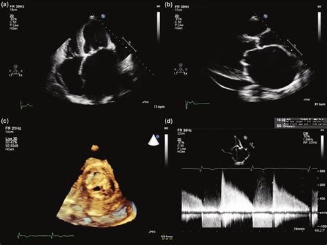 Typical echocardiographic features of mitral stenosis: limited opening... | Download Scientific ...